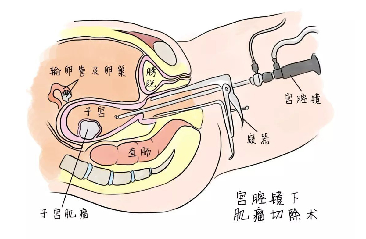 【宮腔鏡】宮腔鏡子宮肌瘤切除術