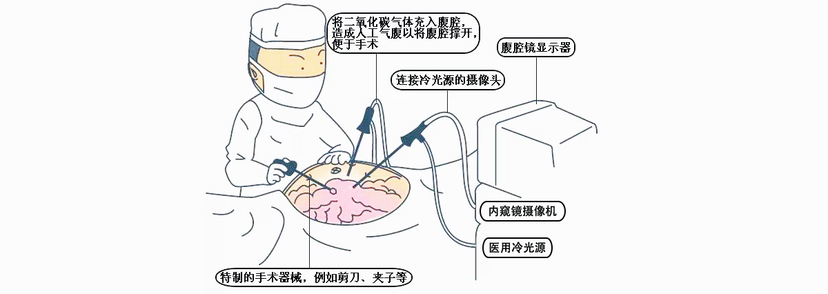 腹腔鏡攝像機使用步驟及注意事項